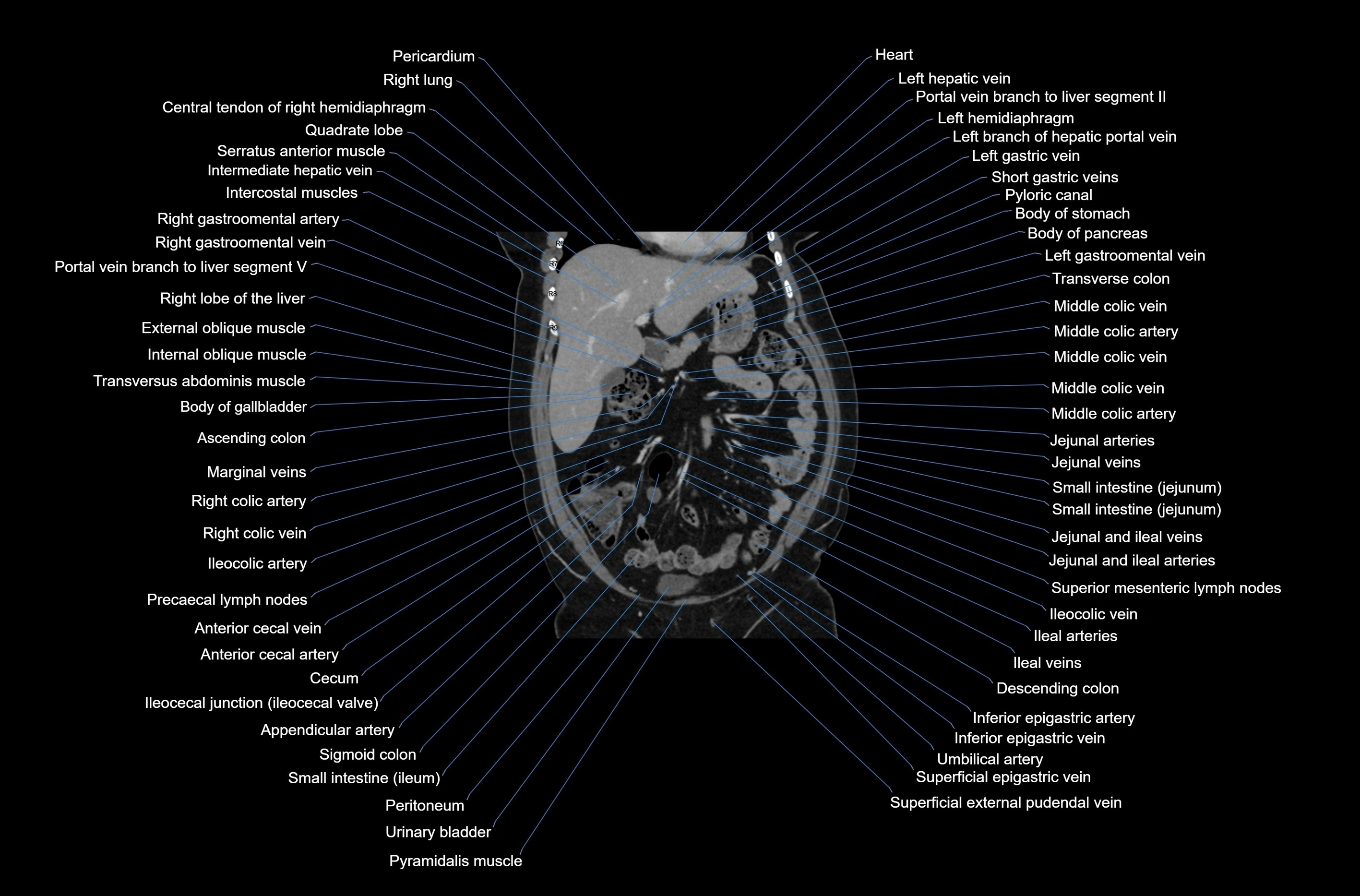 CT abdomen coronal cross sectional anatomy labelled radiology image-00029.webp
